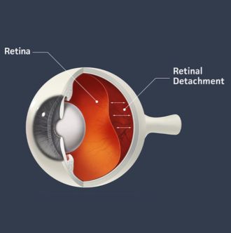 retinal detachment image - what is it